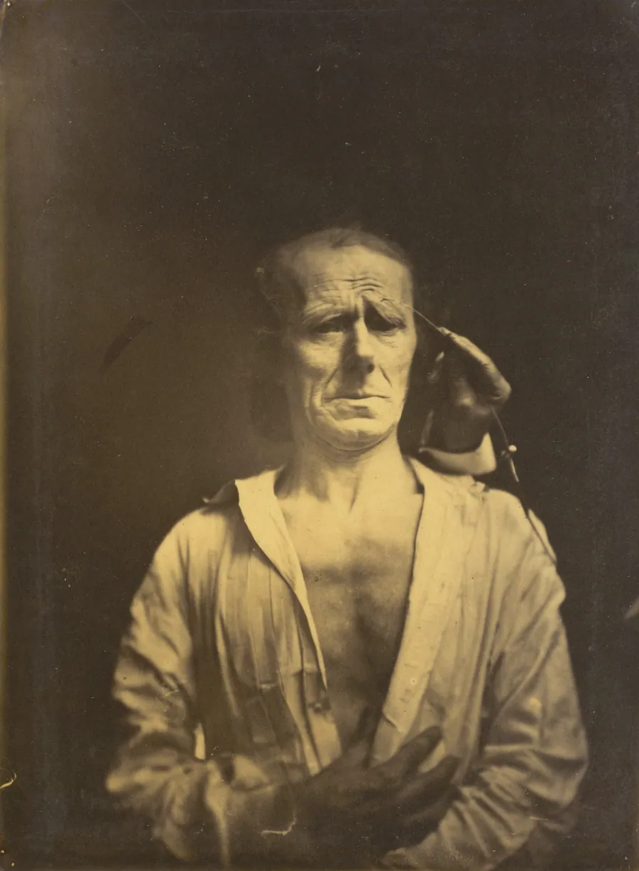 Spasm of m. corrugator supercilii under very strong light (left); A relaxed face (photographed in full sunshine) (right) by Guillaume-Benjamin-Amant Duchenne (de Boulogne)