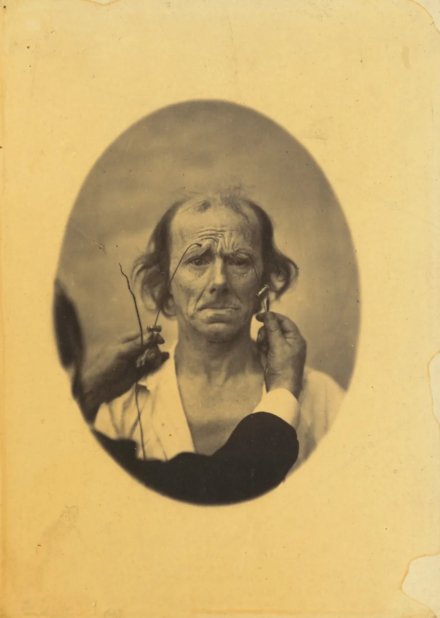 Plate 14: Designed to show a comparison between the maximal contraction of the superior part of m. orbicularis oculi and m. corrugator supercilii, in the same individual. On the left, very strong electrization of the superior part of m. orbicularis oculi: dissatisfaction, somber thoughts. On the right, electrization of m. corrugator supercilii. by Guillaume-Benjamin-Amant Duchenne (de Boulogne)