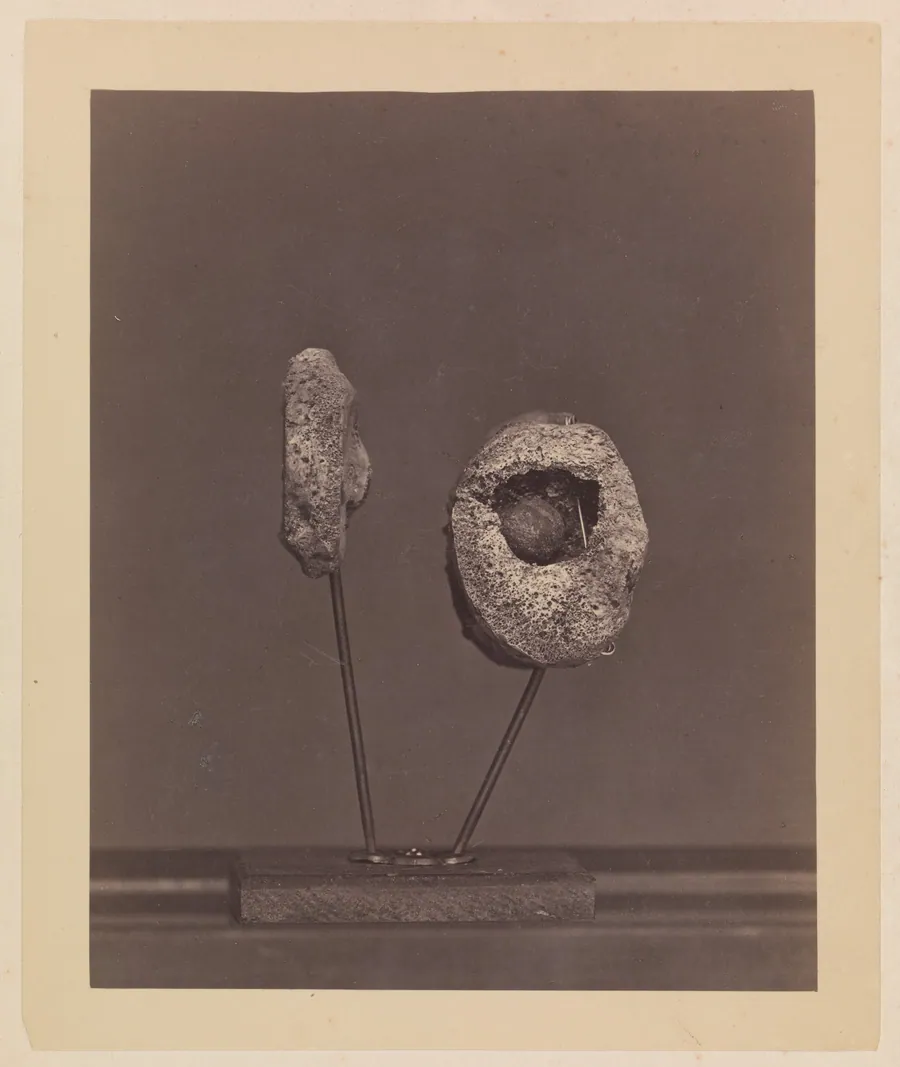 Excised Knee Joint. A Round Musket Ball in the Inner Condyle of the Right Femur [Gardiner Lewis, Company B, Nineteenth Indiana Volunteers] by William Bell