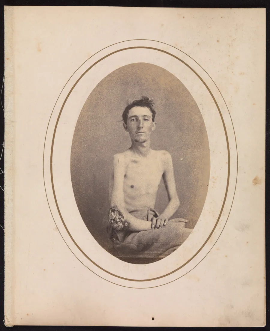 Private James H. Stokes, Company H, 185th New York Volunteers by Reed Brockway Bontecou