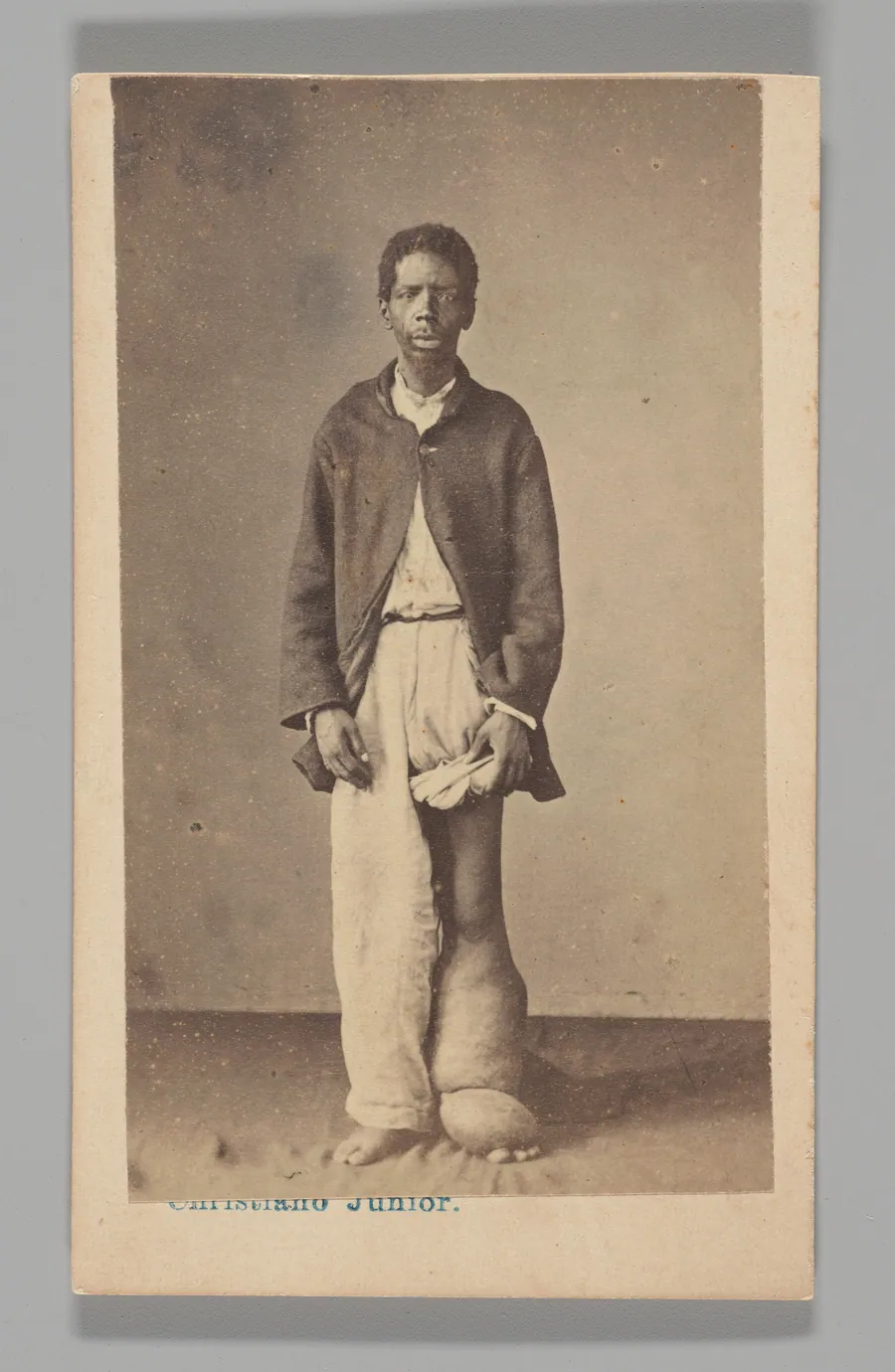 [Studio Portrait: Man Standing with Swollen Leg and Foot Caused by Elephantiasis, Brazil] by Christiano Junior