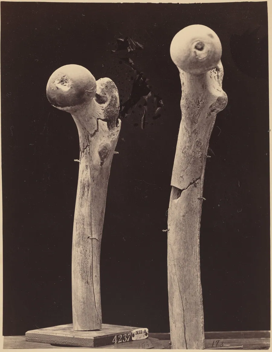 Specimens of Gunshot Fractures of the Femur by American 19th Century