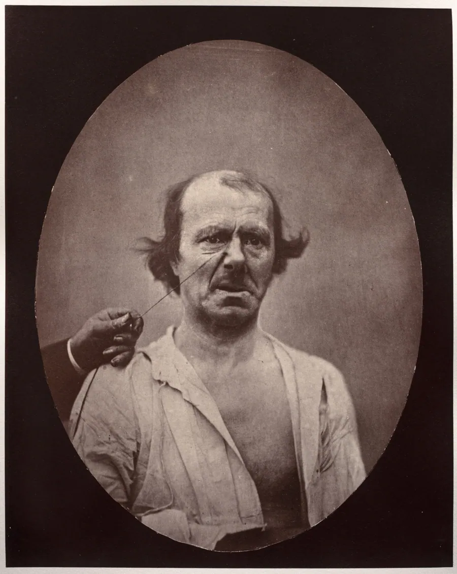 Figure 51: À droite, contraction partielle de l'élévateur commun de l'aile du nez et de la lèvre supérieure: mécontentement, mauvaise humeur; à gauche, repos by Guillaume-Benjamin-Amand Duchenne (de Boulogne)