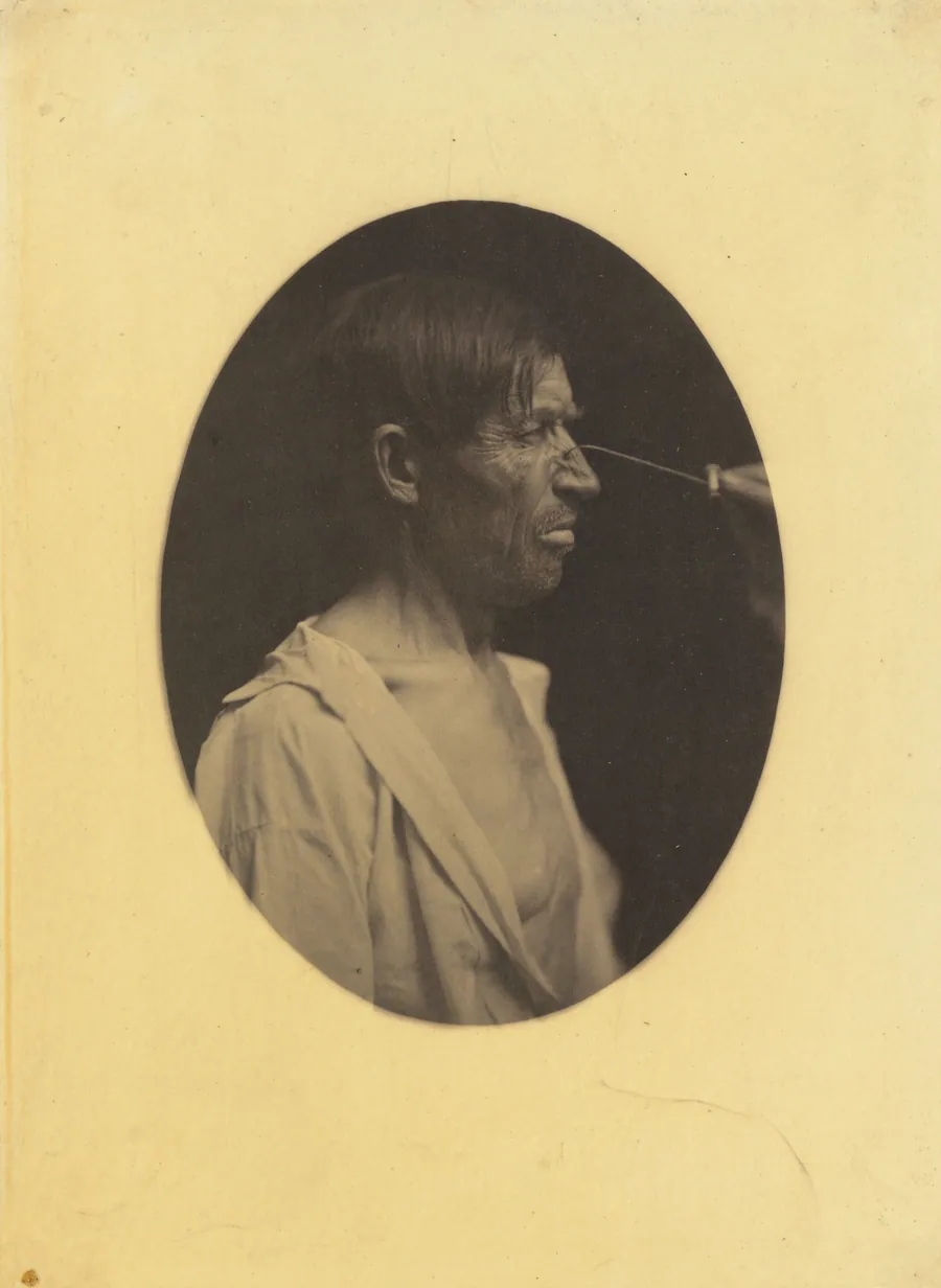 Bad humor, malcontentment by Guillaume-Benjamin-Amant Duchenne (de Boulogne)
