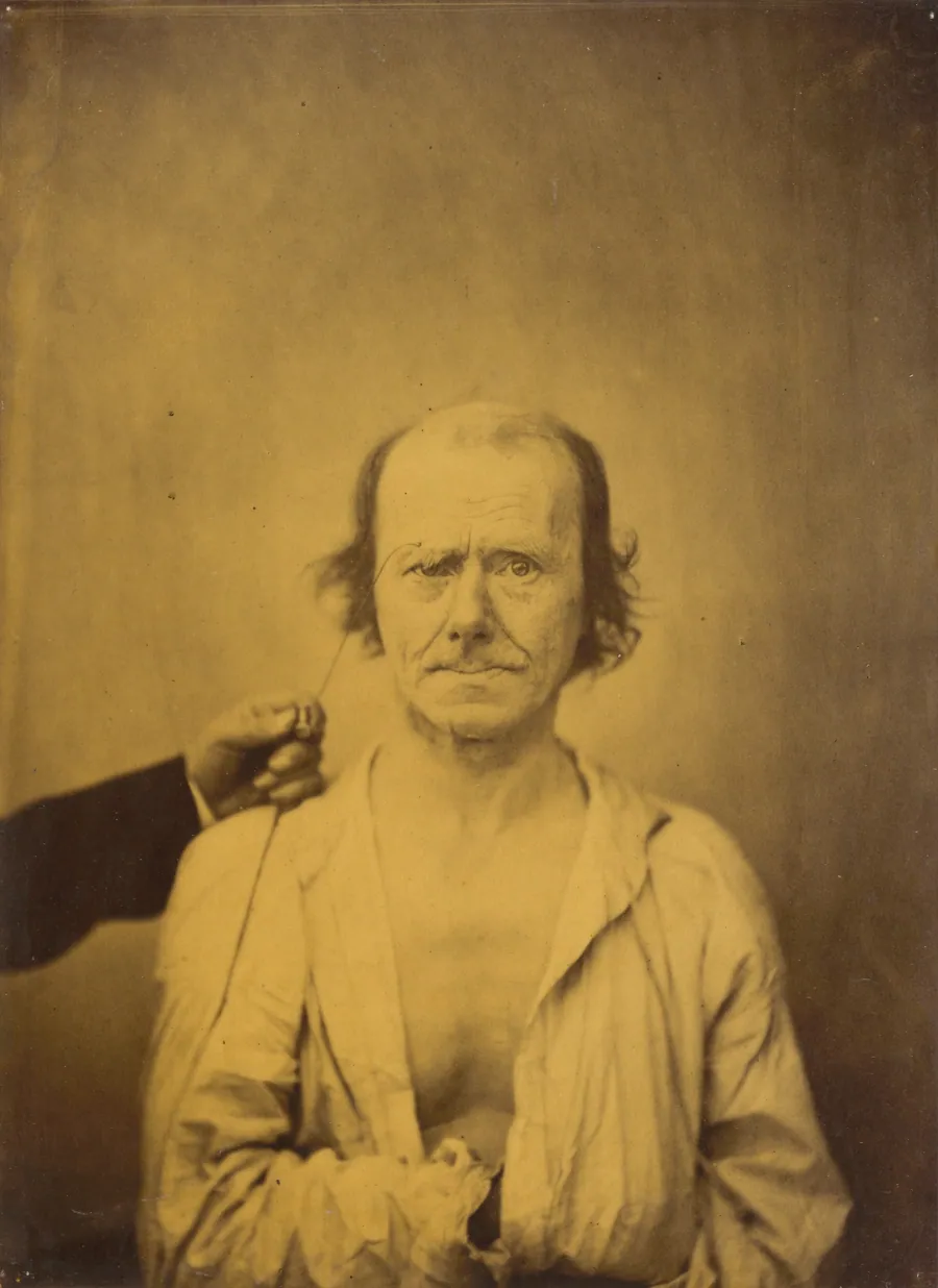Attention (left); Reflection (right) by Guillaume-Benjamin-Amant Duchenne (de Boulogne)