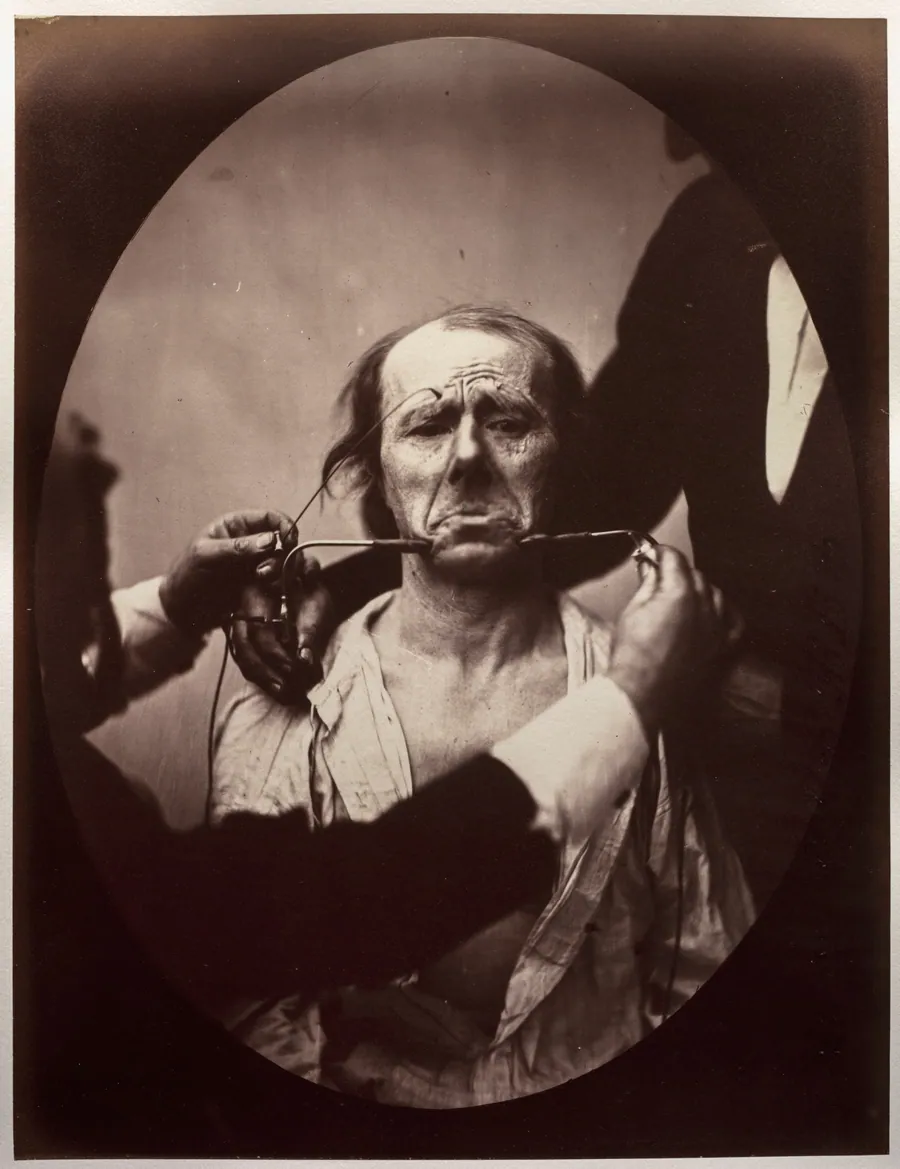 Figure 45: Contraction électrique forte des triangulaires des lèvres et des sourciliers: douleur et déspoir by Guillaume-Benjamin-Amand Duchenne (de Boulogne)