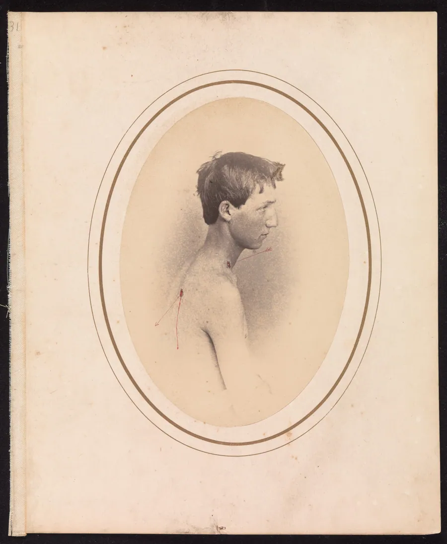Private Jacob F. Simmons, Company H, Eighty-second Pennsylvania Volunteers by Reed Brockway Bontecou
