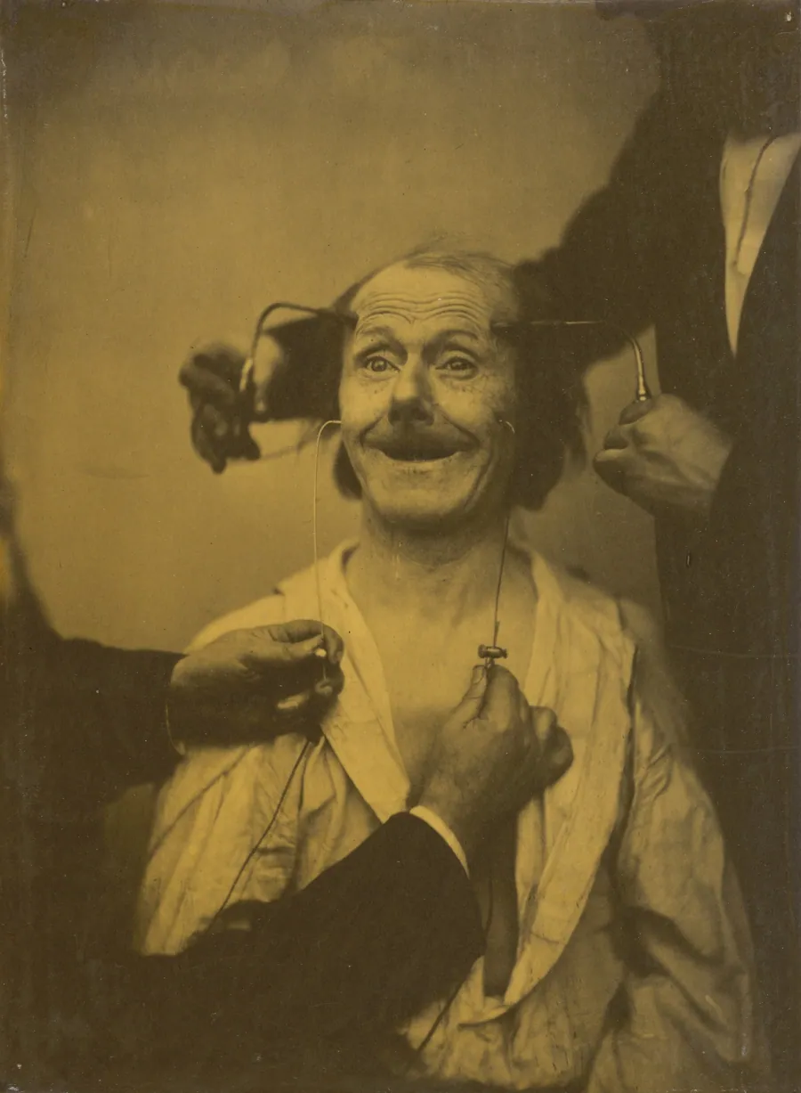 A false, incomplete expression of agreeable surprise, or admiration by Guillaume-Benjamin-Amant Duchenne (de Boulogne)