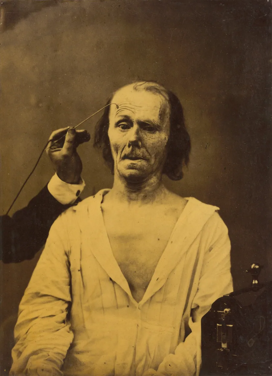 A relaxed face (left); Profound attention (right) by Guillaume-Benjamin-Amant Duchenne (de Boulogne)