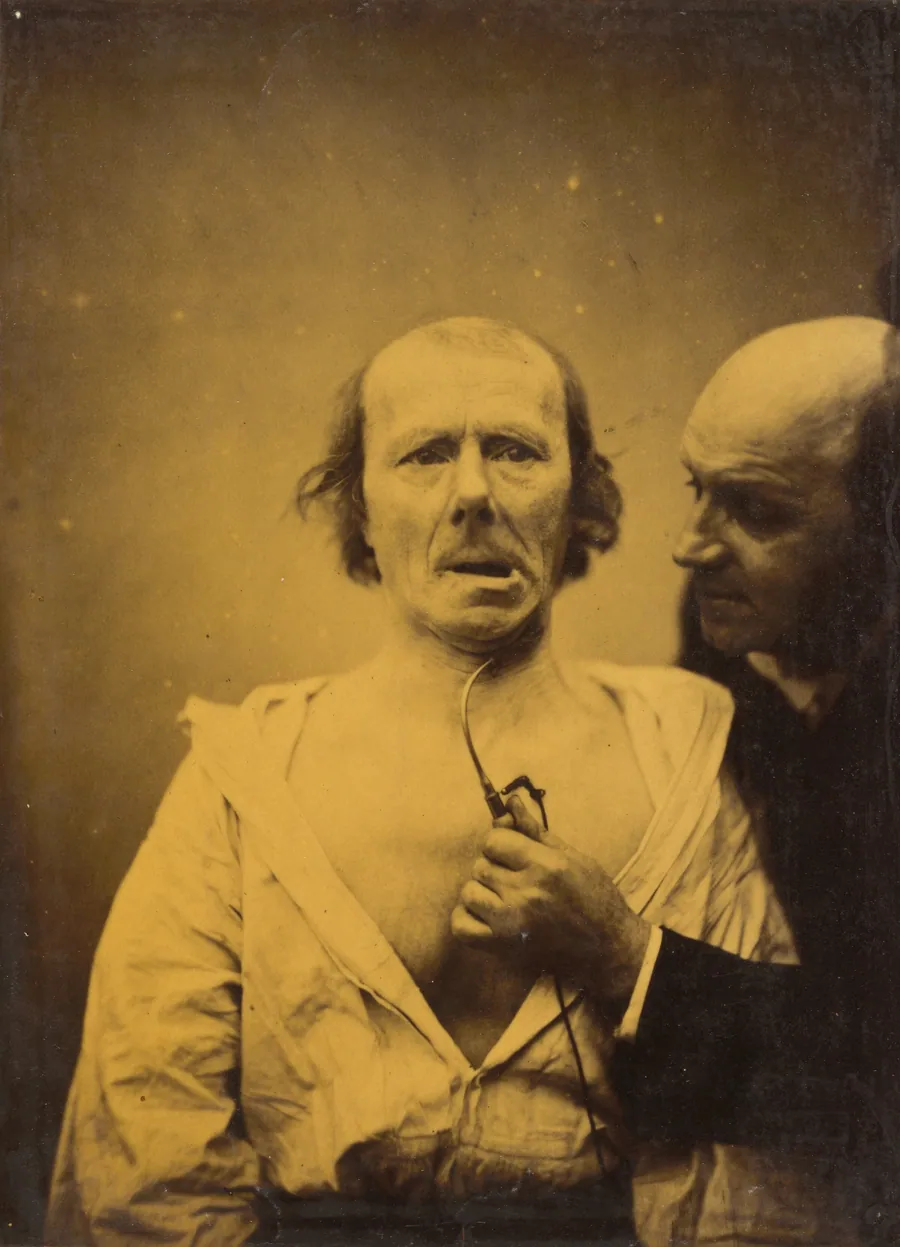 This contraction of m. platysma alone lacks expression by Guillaume-Benjamin-Amant Duchenne (de Boulogne)