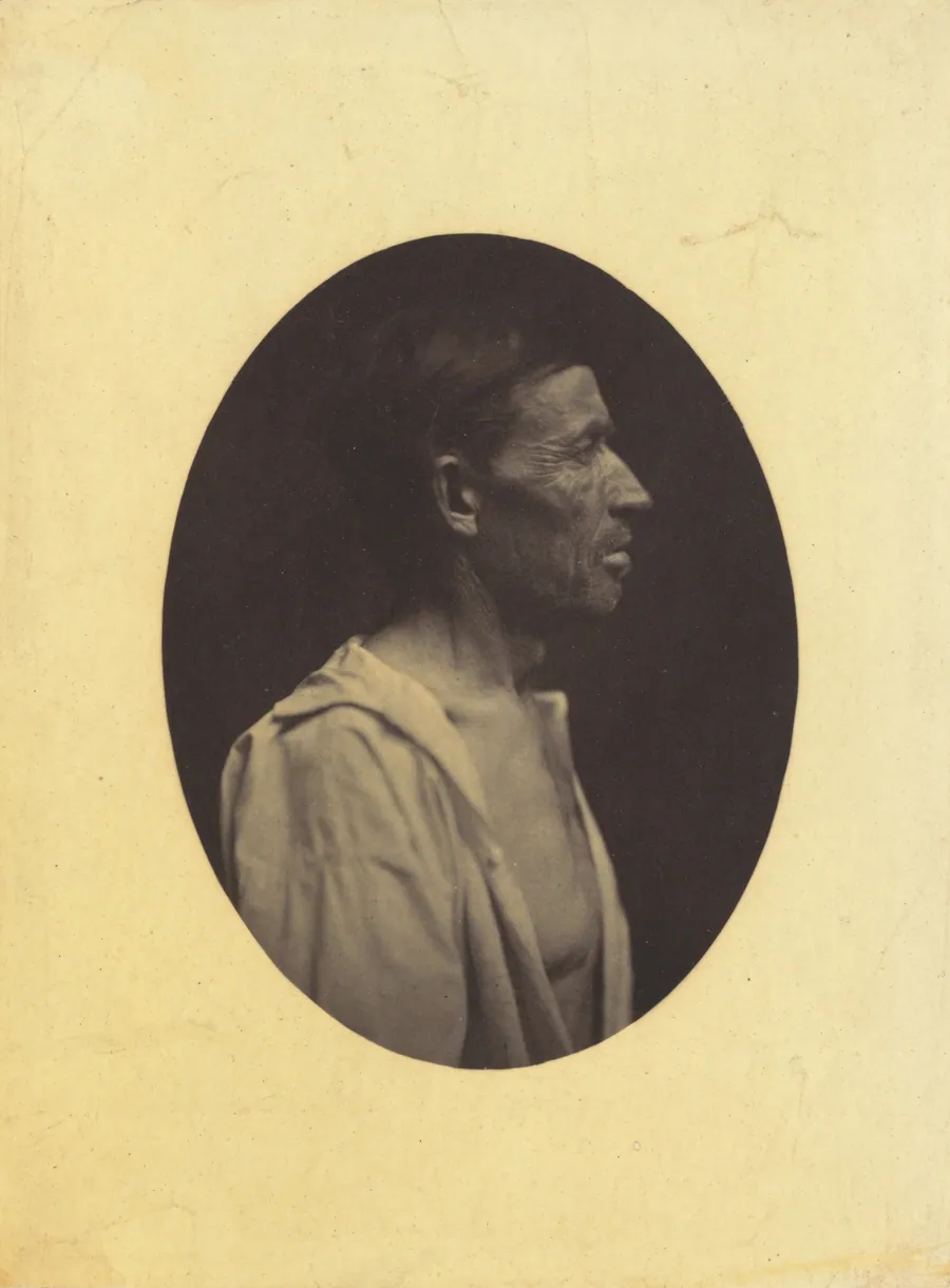 A portrait, seen in profile, of a man 42 years old, stupefied by the abuse of alcohol; his nose is aquiline by Guillaume-Benjamin-Amant Duchenne (de Boulogne)