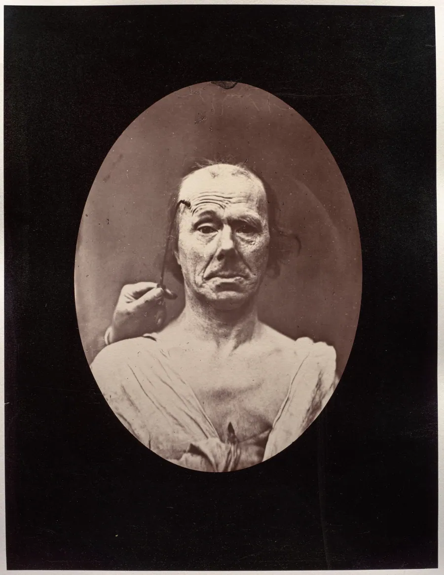 Figure 7: Étude du méchanisme et de l'expression du muscle frontal chez un vieillard: à droit, attention; à gauche, repos by Guillaume-Benjamin-Amand Duchenne (de Boulogne)