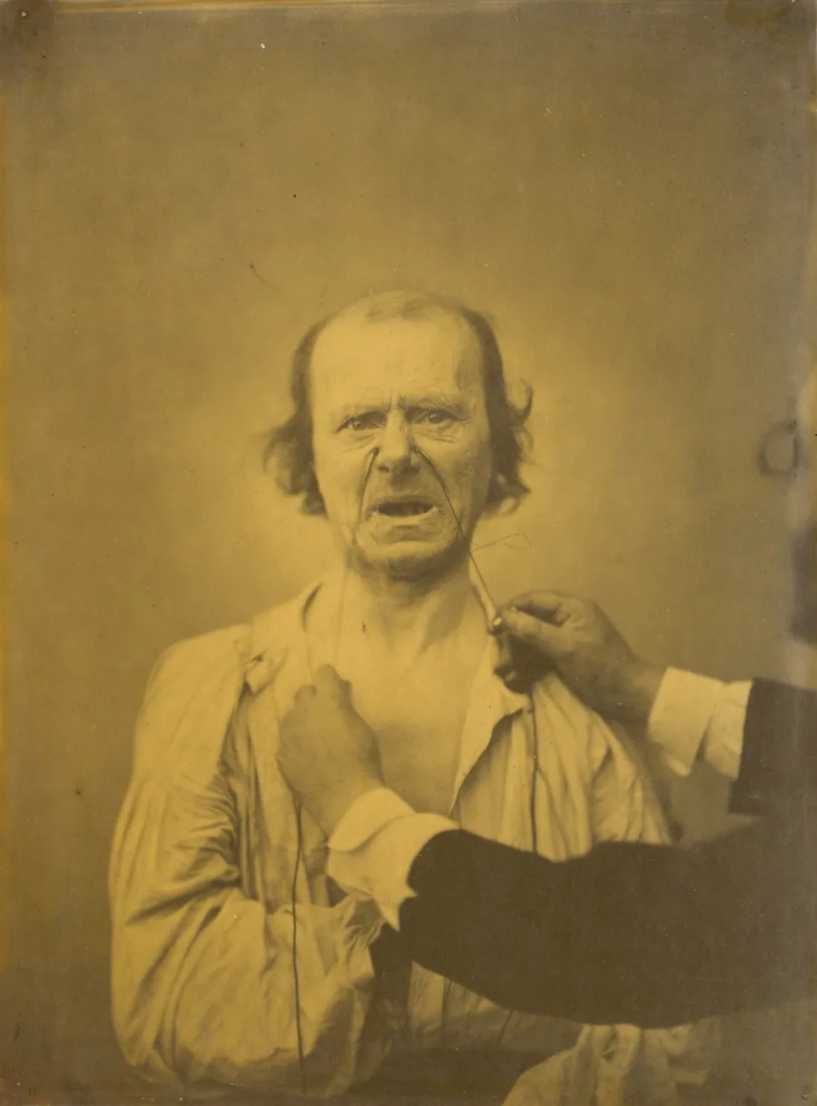 Discontent, bad humor by Guillaume-Benjamin-Amant Duchenne (de Boulogne)