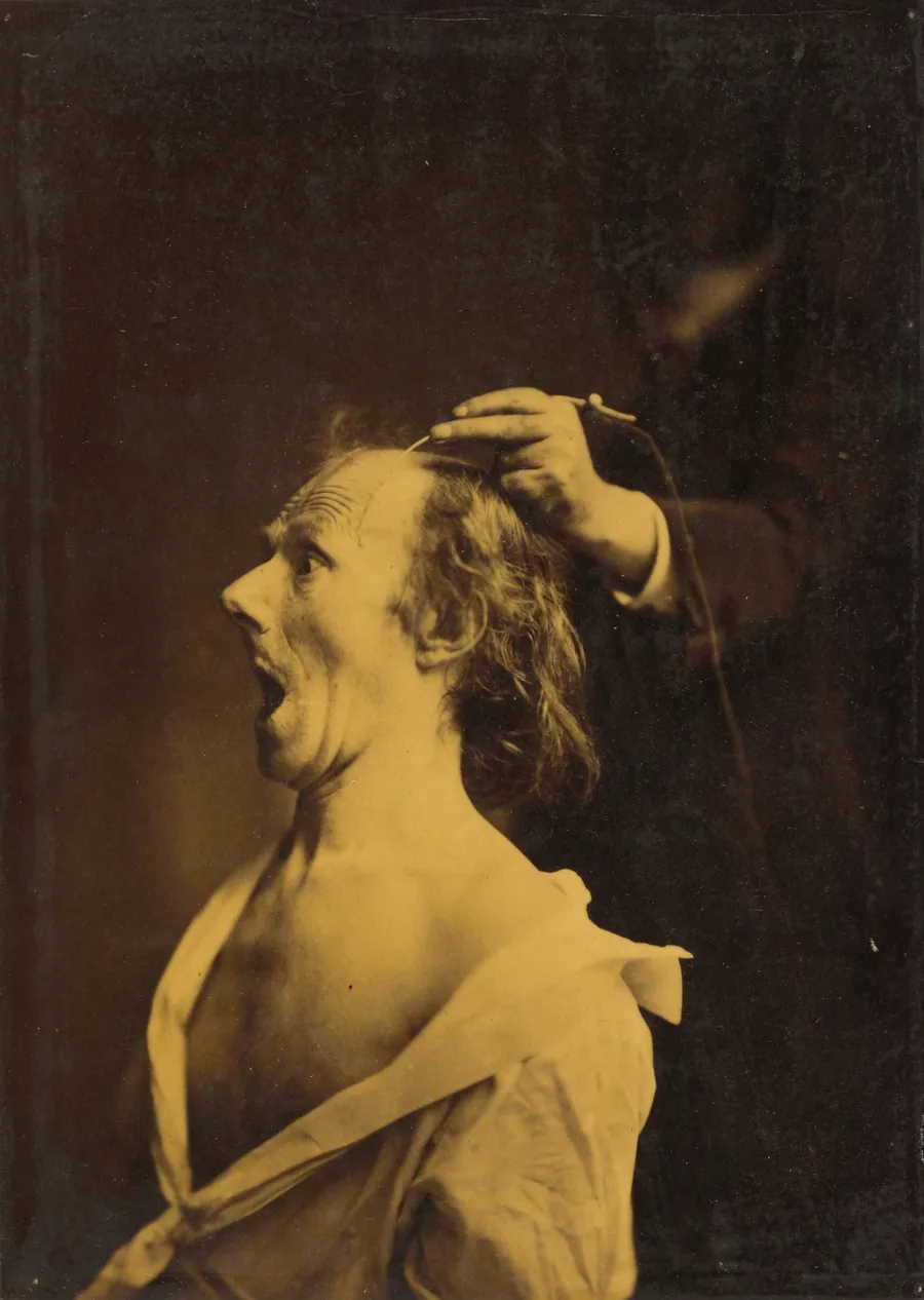Astonishment, stupefaction, amazement by Guillaume-Benjamin-Amant Duchenne (de Boulogne)