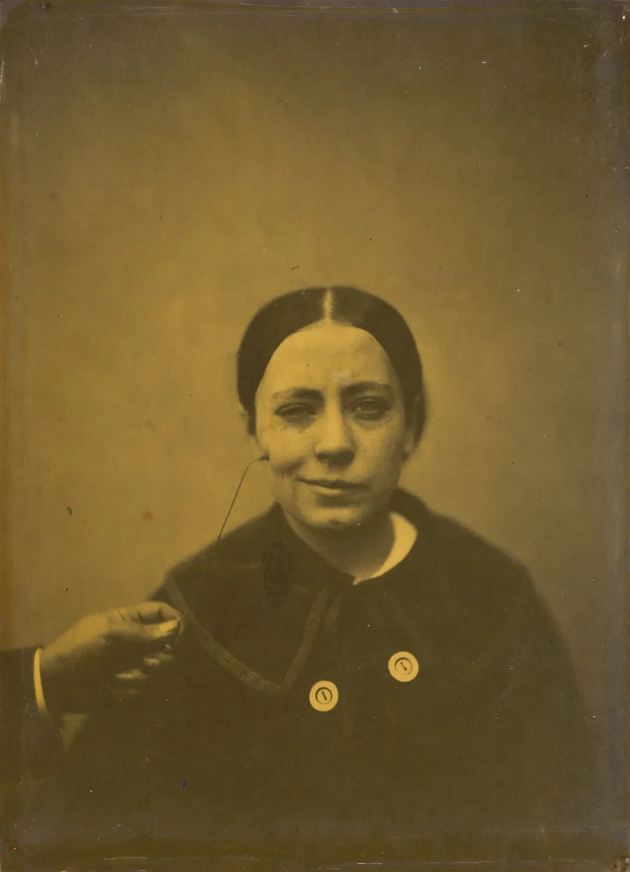 Slight lowering of the angle of the mouth due to depression (left); False laughter (right) by Guillaume-Benjamin-Amant Duchenne (de Boulogne)