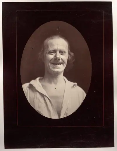 Figure 32: Natural laughter by the voluntary contraction of the two large zygomatics and the lower palpebral orbicularis