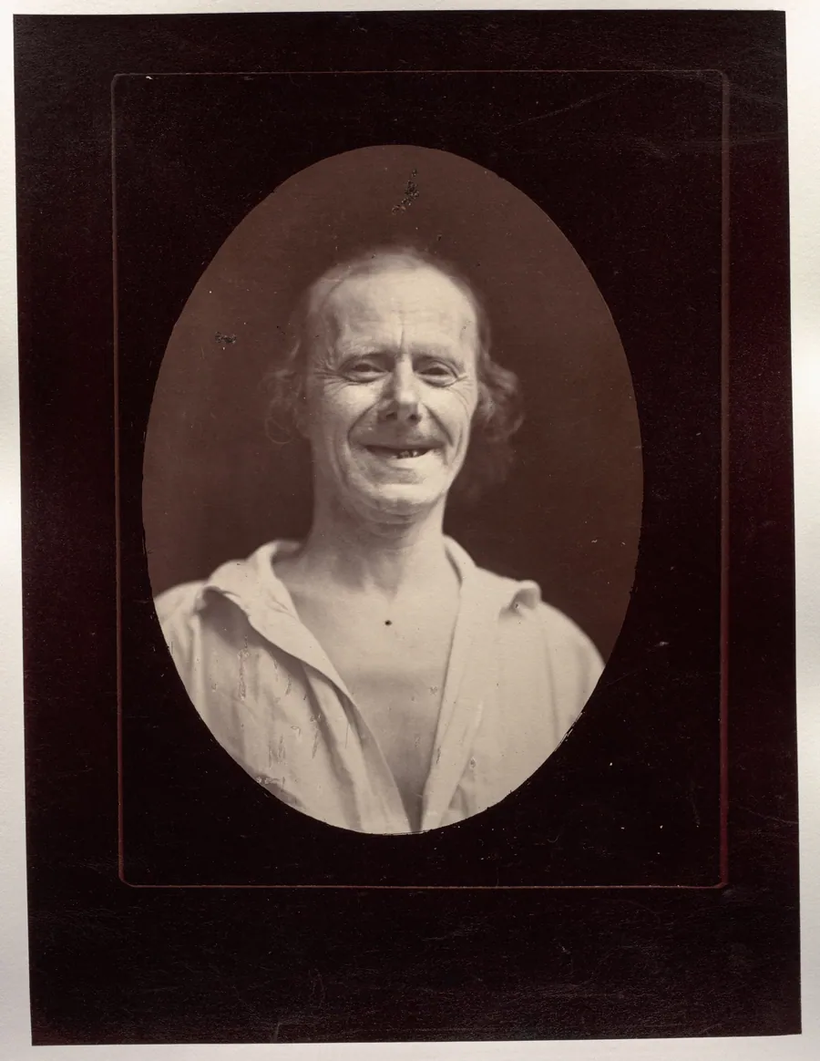 Figure 32: Natural laughter by the voluntary contraction of the two large zygomatics and the lower palpebral orbicularis by Guillaume-Benjamin-Amand Duchenne (de Boulogne)