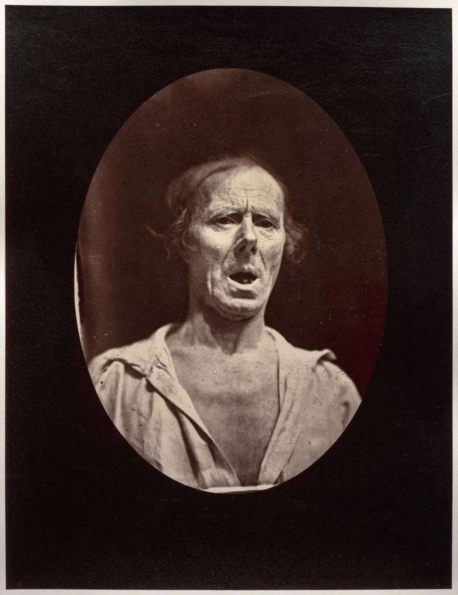 Figure 54: Abaissement volontaire de la mâchoire inférieure: mouvement inexpressif by Guillaume-Benjamin-Amand Duchenne (de Boulogne)